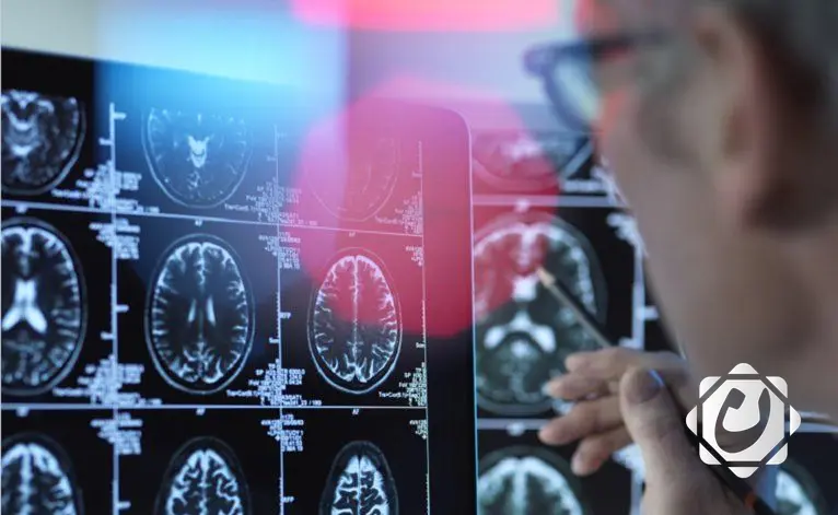 اكتشاف مركبات طبيعية قد تحمي الدماغ من الزهايمر