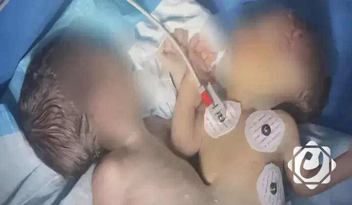 إجراء أول عملية لفصل توأم سيامي في كركوك بنجاح