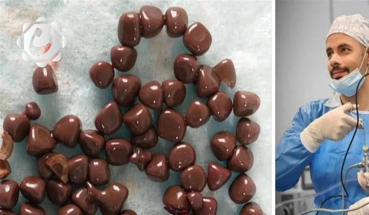 فريق طبي يجري عملية ناجحة لاستخراج 100 حصوة كلوية في النجف