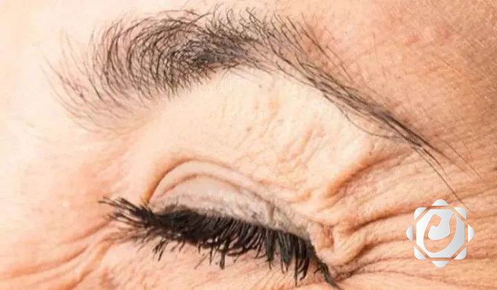 تجاعيد العين قد تشير إلى خطر الخرف والزهايمر
